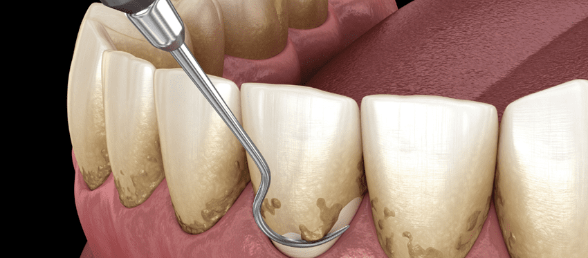 非外科的歯周病治療：優しいケアで健康な歯へ