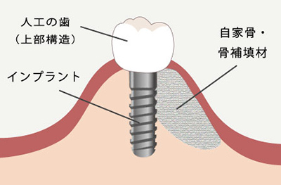文京区後楽園でインプラント治療なら文京いわぶち歯科・矯正歯科｜GBR