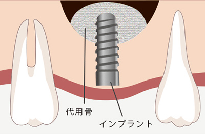 文京区後楽園でインプラント治療なら文京いわぶち歯科・矯正歯科｜ソケットリフト