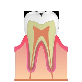 むし歯の進行　C1