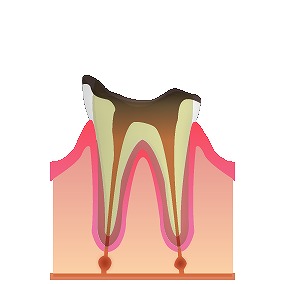 むし歯の進行 C4