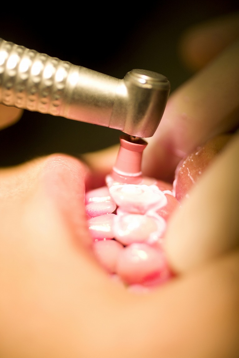 専門家による歯のクリーニング PMTCについて