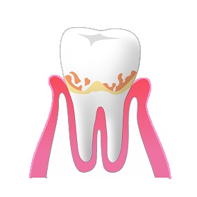 歯周病初期