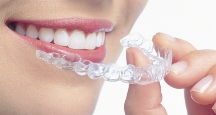 お口元をより美しくするための目立たない矯正歯科治療