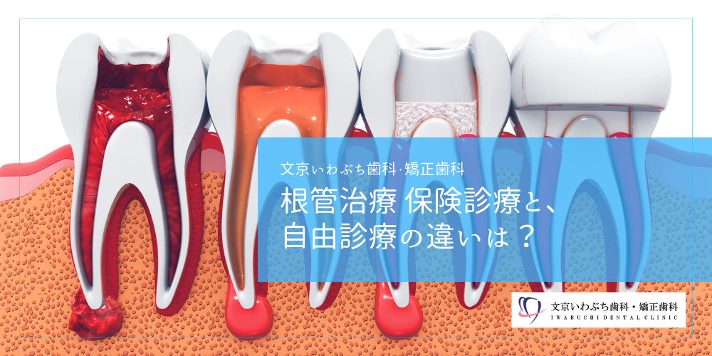 根管治療 保険診療と、自由診療の違いは？