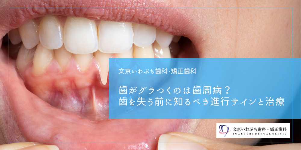 歯がグラつくのは歯周病？歯を失う前に知るべき進行サインと治療