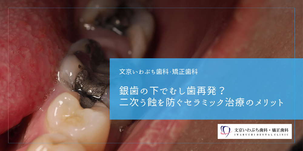 銀歯の下でむし歯再発？二次う蝕を防ぐセラミック治療のメリット